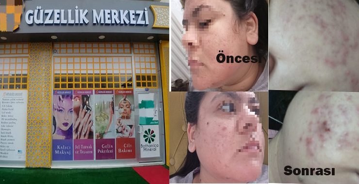 Akne problemi ile güzellik merkezine gitti, 3 seansın sonunda hastanelik oldu…